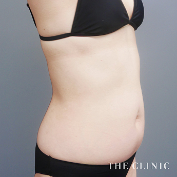 ポッコリお腹を何とかしたいの（50代）術前症例画像