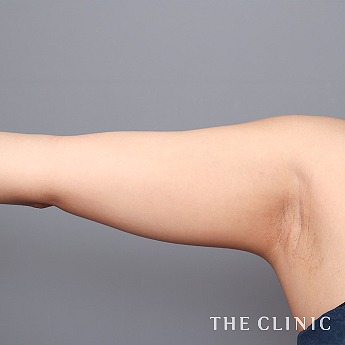 二の腕の（20代）術前症例画像