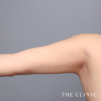 二の腕の（20代）術後症例画像