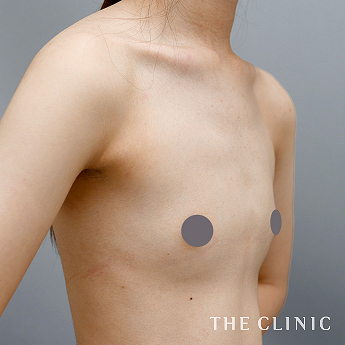 ボリュームアップの(20代)術前症例画像