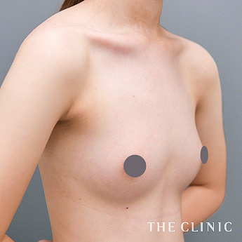 ボリュームアップの(20代)術後症例画像