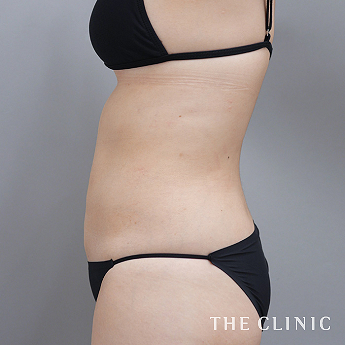 腹部の（30代）術後症例画像