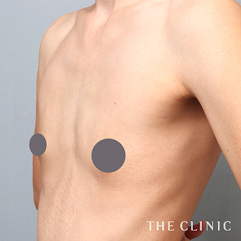 ボリュームアップの(30代)術前症例画像