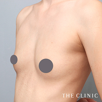 ボリュームアップの(30代)術後症例画像