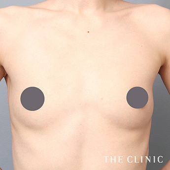 ボリュームアップの(30代)術前症例画像