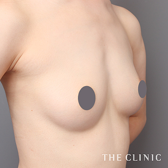 ボリュームアップの(20代)術前症例画像