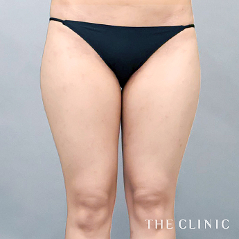 太ももの（20代）術前症例画像