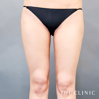 太ももの（20代）術後症例画像