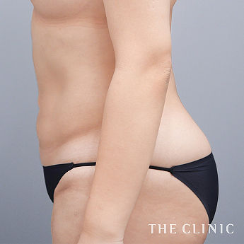 腹部の（20代）術後症例画像