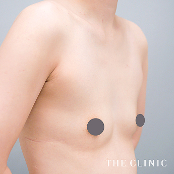 授乳後のたるみの(30代)術前症例画像