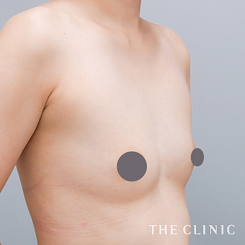 授乳後のたるみの(30代)術後症例画像