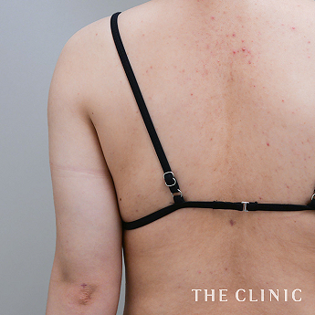 二の腕の（20代）術後症例画像