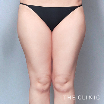 太ももの（30代）術前症例画像