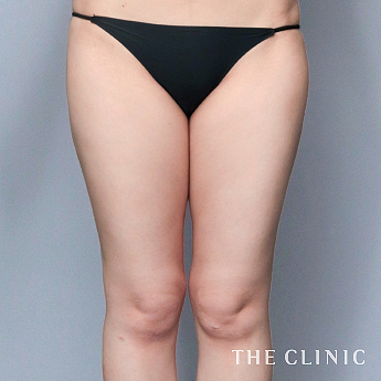 太ももの（30代）術後症例画像