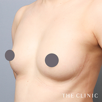 ボリュームアップの(40代)術後症例画像