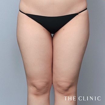 太ももの（20代）術前症例画像