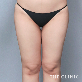 太ももの（20代）術後症例画像