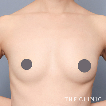 ボリュームアップの(30代)術前症例画像