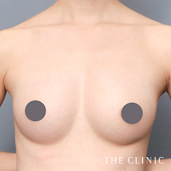 ボリュームアップの(30代)術後症例画像