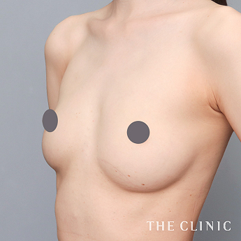 ボリュームアップの(30代)術前症例画像