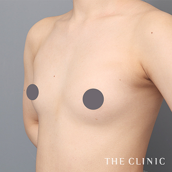 ボリュームアップの(20代)術前症例画像