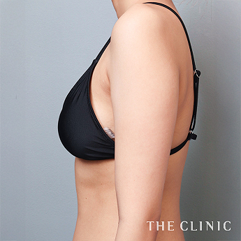 二の腕の（20代）術前症例画像