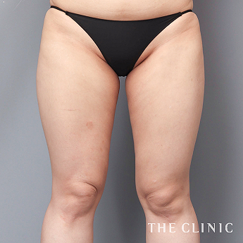 太ももの（20代）術前症例画像