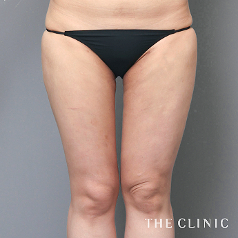 太ももの（20代）術後症例画像