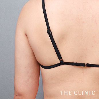 二の腕の（20代）術後症例画像