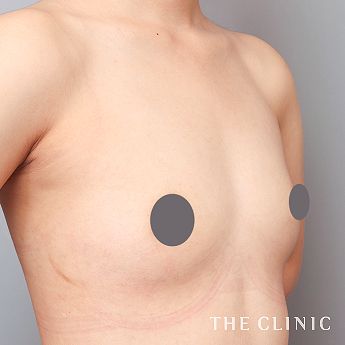 ボリュームアップの(20代)術前症例画像