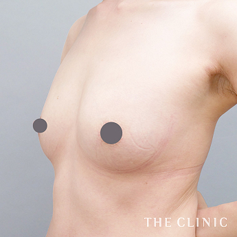 ボリュームアップの（40代）術後症例画像