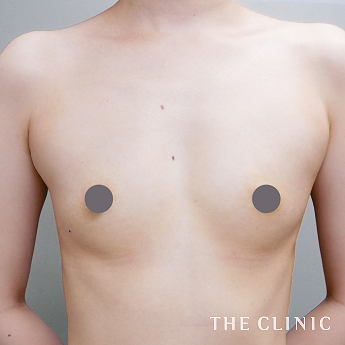 ボリュームアップの（30代）術前症例画像