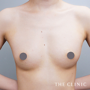 ボリュームアップの（30代）術後症例画像