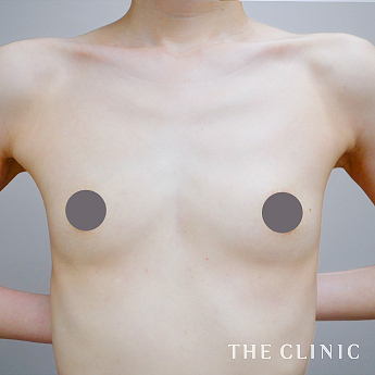 ボリュームアップの（40代）術前症例画像