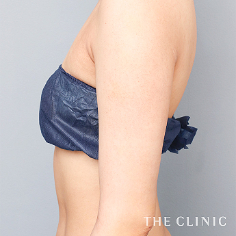 二の腕の（20代）術後症例画像