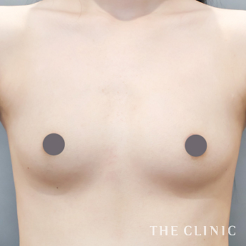 ボリュームアップの（20代）術前症例画像