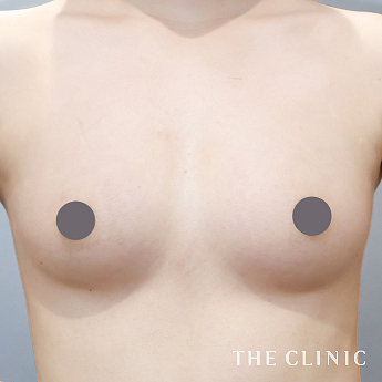 ボリュームアップの（20代）術後症例画像