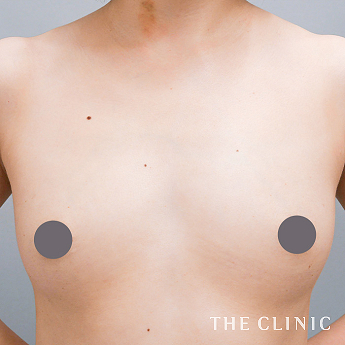 ボリュームアップの（20代）術前症例画像