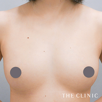 ボリュームアップの（20代）術後症例画像