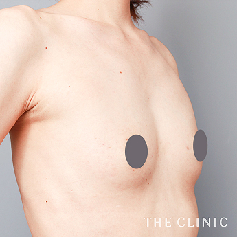 ボリュームアップの（30代）術前症例画像