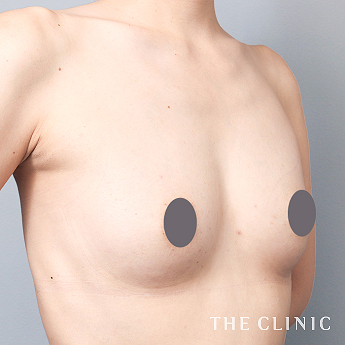 ボリュームアップの（30代）術後症例画像