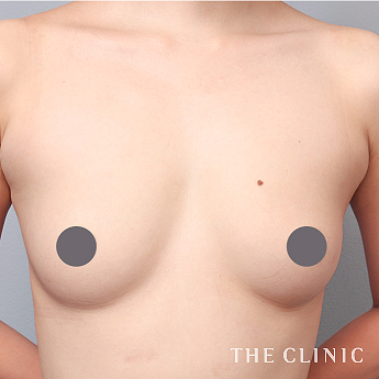 ボリュームアップの（20代）術前症例画像