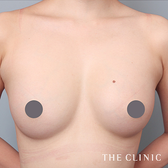 ボリュームアップの（20代）術後症例画像