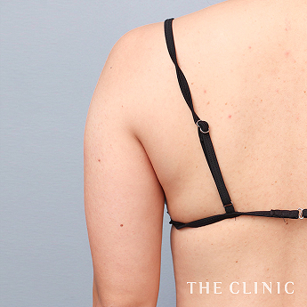 二の腕の（30代）術前症例画像