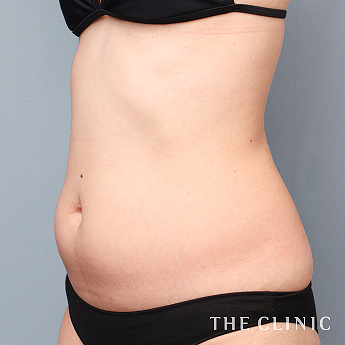 ポッコリお腹を何とかしたいの（30代）術前症例画像