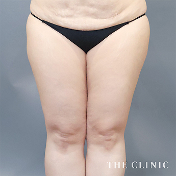 太ももの（40代）術前症例画像