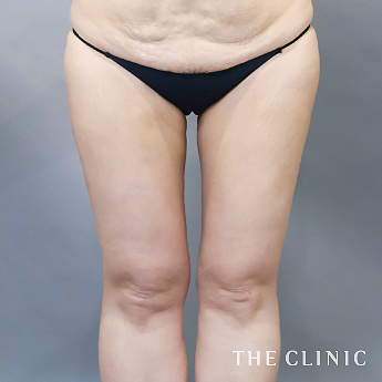 太ももの（40代）術後症例画像