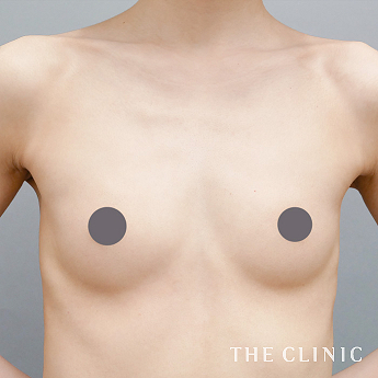 ボリュームアップの（30代）術前症例画像