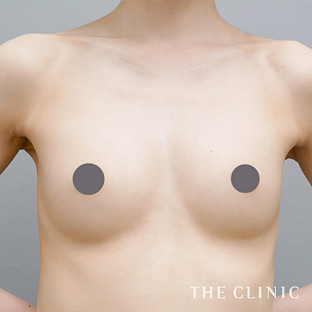 ボリュームアップの（30代）術後症例画像