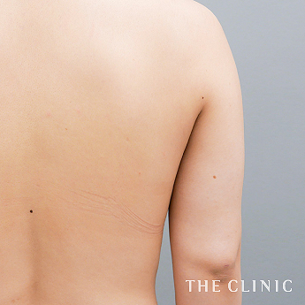 二の腕の（20代）術後症例画像